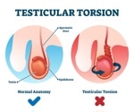 What Is Testicular Torsion?