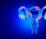 Recent Advances in the Treatment of Endometriosis
