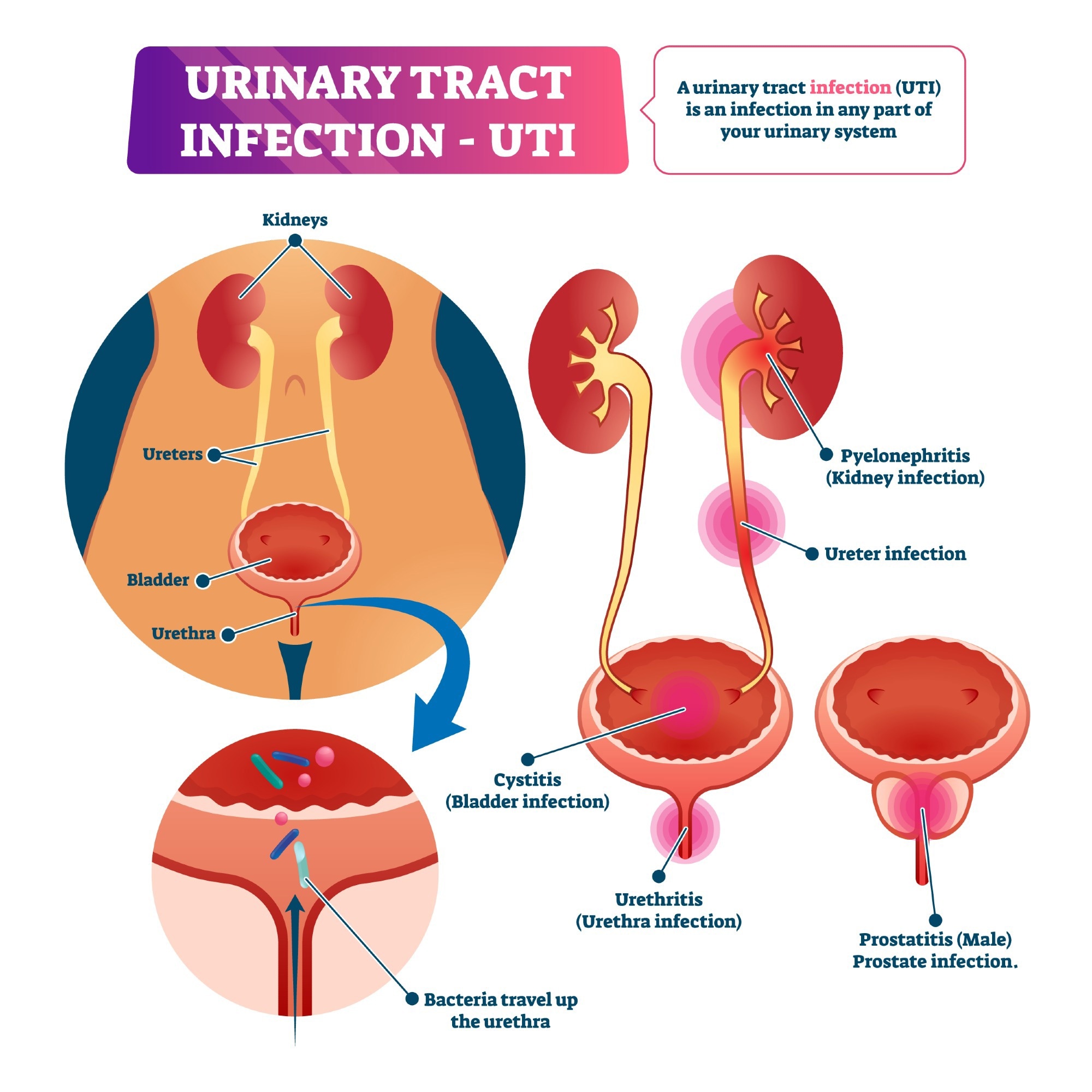 Pregnancy and Urinary Tract Infections (UTIs)