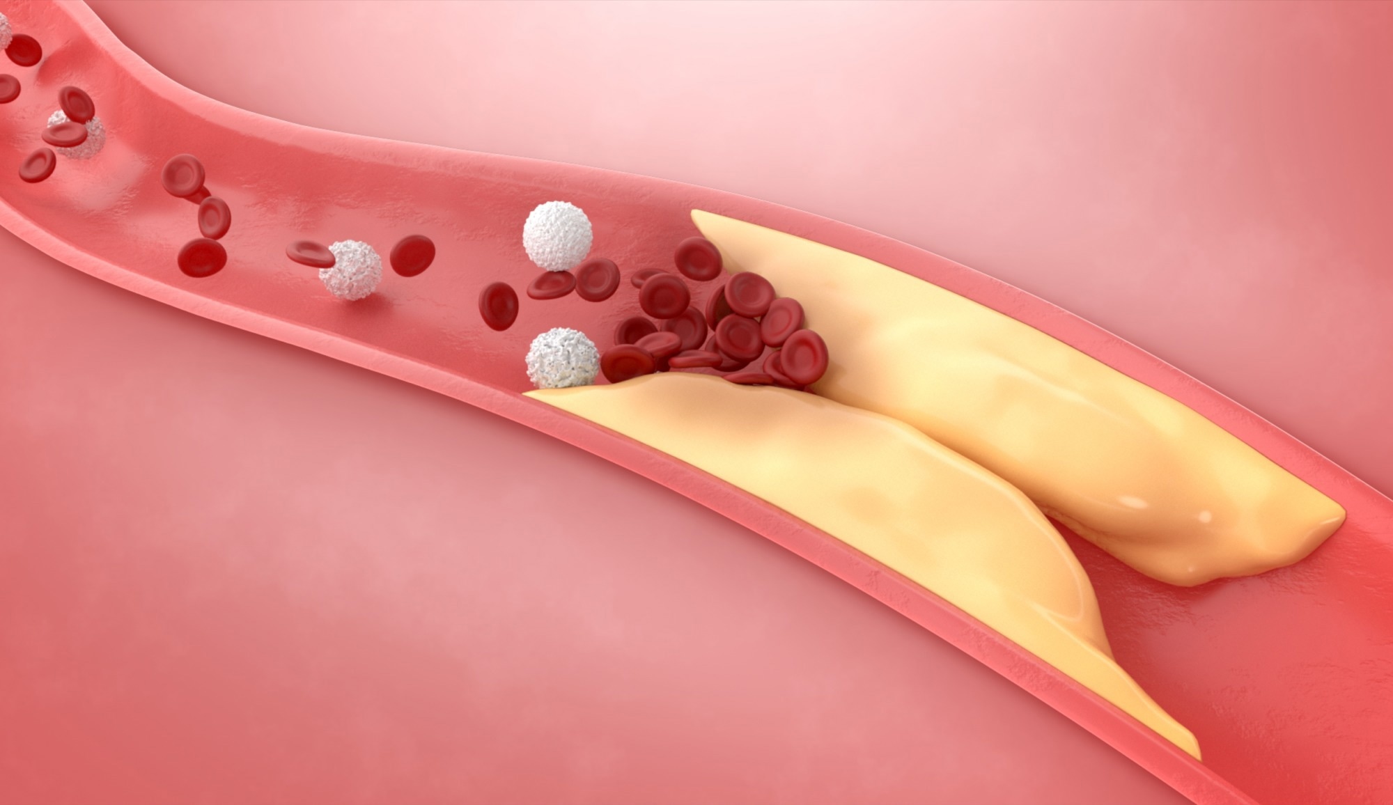 Thickened arteries and veins with cholesterol