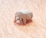 What Treatment Options are Available for Scabies?