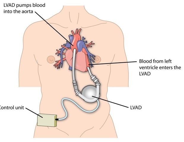 Exploring Ventricular Assist Devices