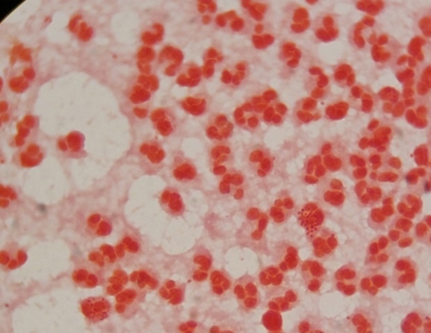 The Impact of Antimicrobial Resistance on STDs