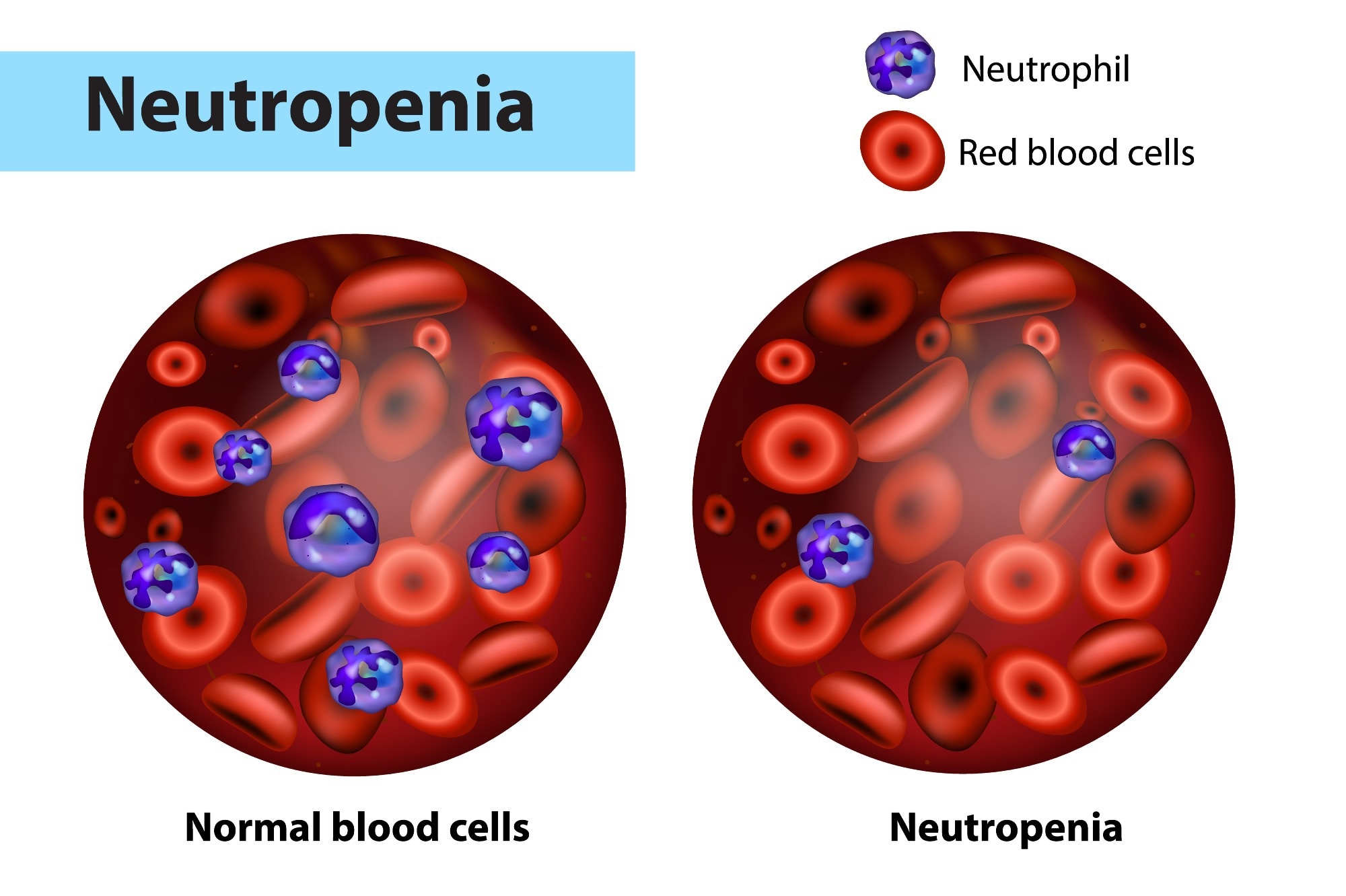 Neutropenia and normal blood cells. Image Credit: Sakurra / Shutterstock