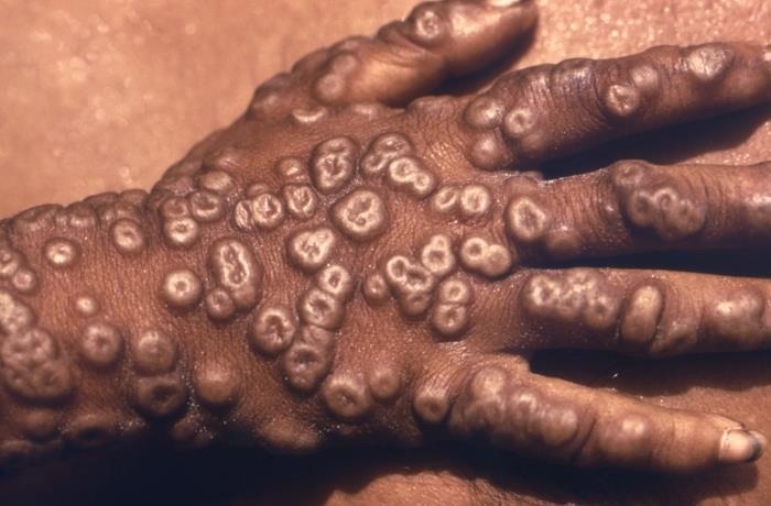 This 1973 image depicts the dorsum of a Bangladeshi smallpox patient’s right hand, revealing the numerous umbilicated maculopapular lesions which are characteristic of this viral illness.