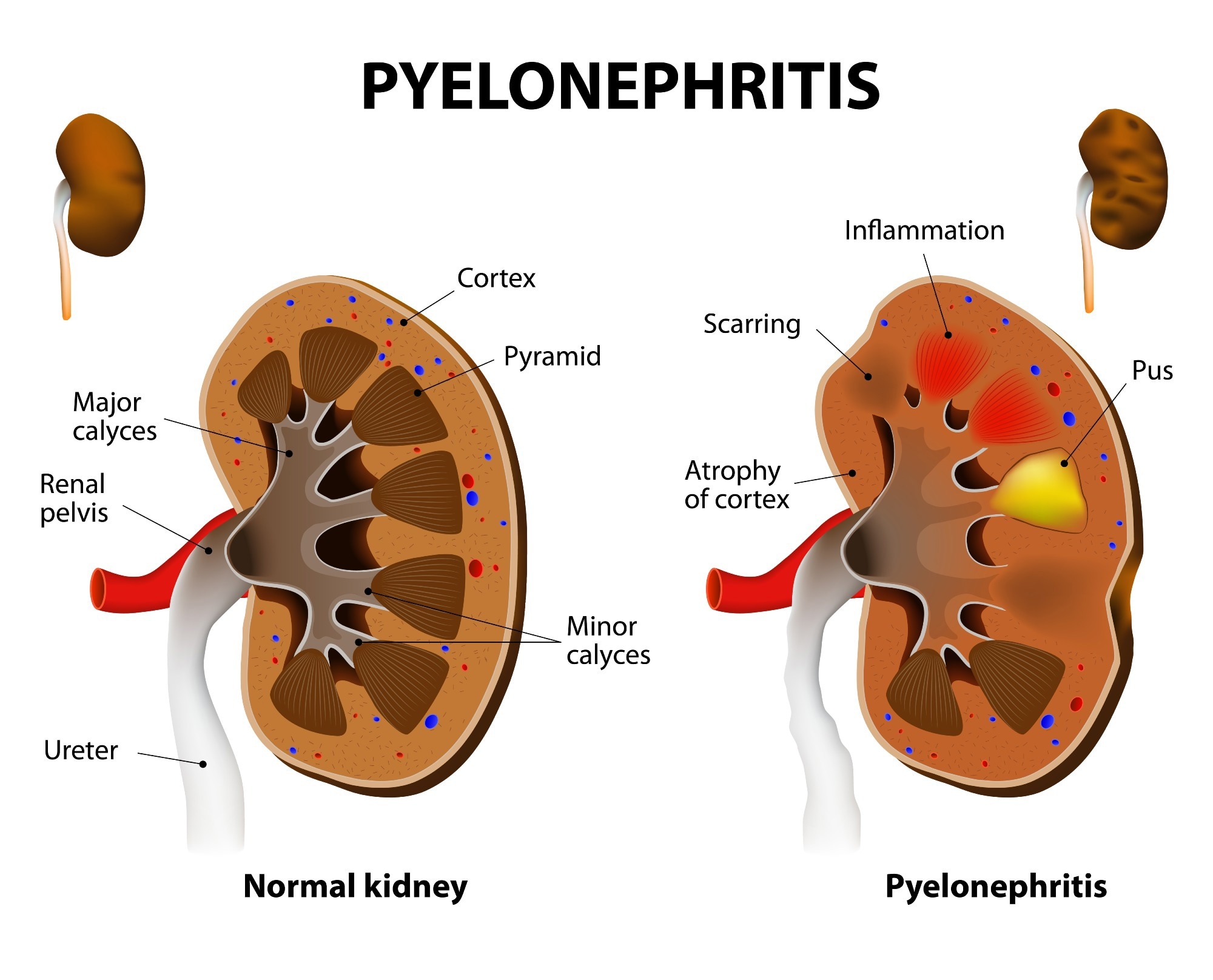 Pyelonephritis. Image Credit: Designua / Shutterstock