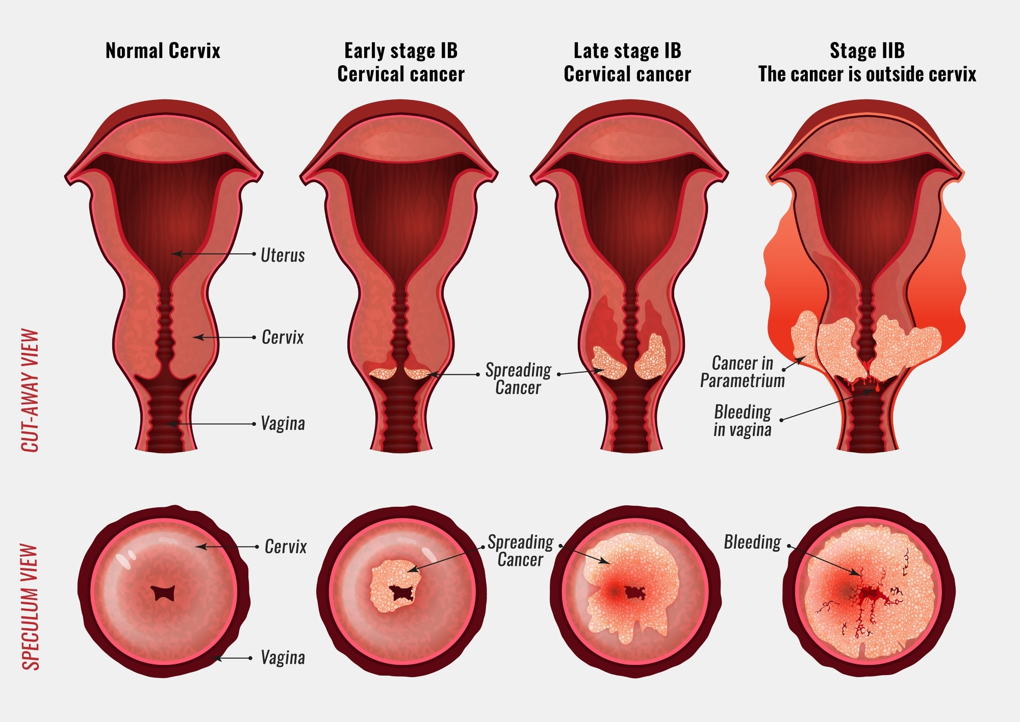 Cervical cancer development image. Image Credit: Double Brain / Shutterstock