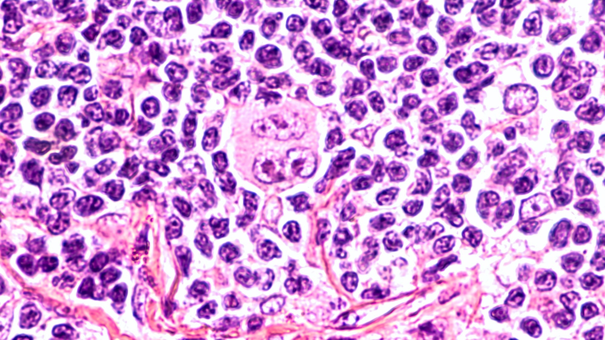 Photomicrograph of a lymph node in a patient with Hodgkin