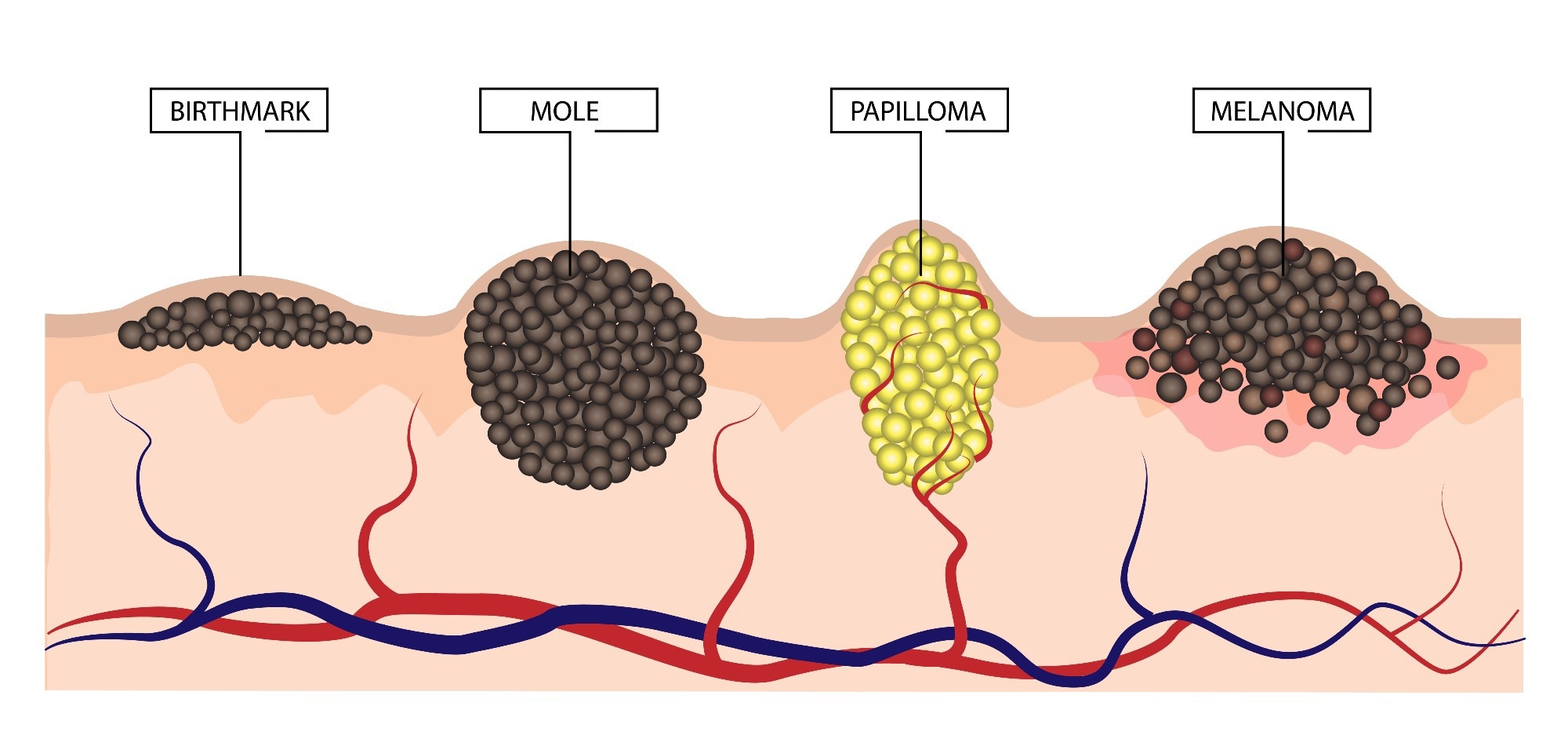 Diagram of birthmark, mole, papilloma and melanoma. Image Credit: LiliiaKyrylenko / Shutterstock
