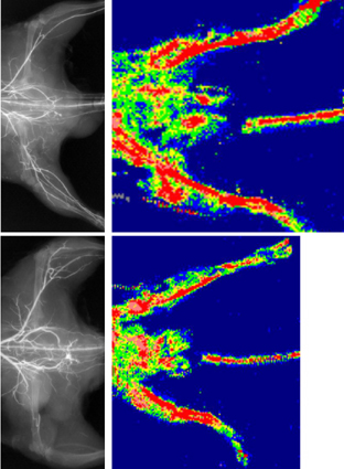 Lactadherin, a key player in angiogenesis In this experiment in mice, the femoral artery in the thigh was ligated (bottom half of images), thus stopping the blood flow. In the two images on the left, blood vessels reformed (“bypassing” the blockage). In contrast, when lactadherin was inhibited, angiogenesis did not take place upon VEGF treatment, and no new blood vessels were formed (two images on the right). „ J.-S. Silvestre/Inserm U689/Hôpital Lariboisière