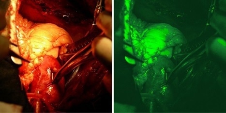 (Left) RGB image during ICG Surgery and (Right) IR image during ICG Surgery.