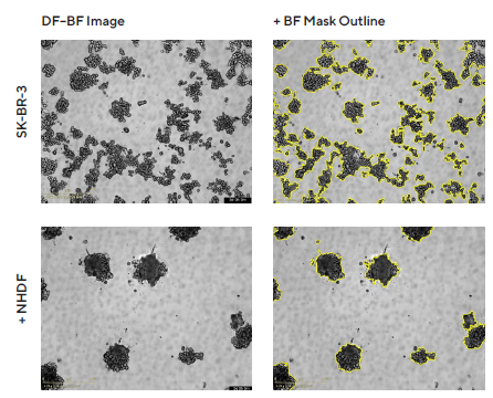 Morphology observations with Incucyte® DF-BF images and quantification of multi-spheroid size and kinetic growth using real-time analysis. SK-BR-3 cells were seeded in flat bottom, 96-well plates on a bed of Matrigel in mono- or co-culture with NHDFs (1:1 ratio, 1,000 cells/well for each) and multi-spheroids (MS) allowed to form (3 d). Incucyte® extended depth of focus Brightfield (DF Brightfield) images (8 d post cell seeding) of SK-BR-3 MS in mono- or co-culture with NHDFs. Brightfield outline mask shown in yellow. Note, the influence of NHDFs on SK-BR-3 MS morphology and size (Total Area). Time course plots show the individual well Total Brightfield Object Area (μm2) (y-axis) over time (h) (x-axis) and illustrate cell type specific kinetic growth profiles for a range of breast tumor MS co-cultured with NHDFs. Data were collected over 192 h period at 6 h intervals. Each data point represents mean ± SEM,