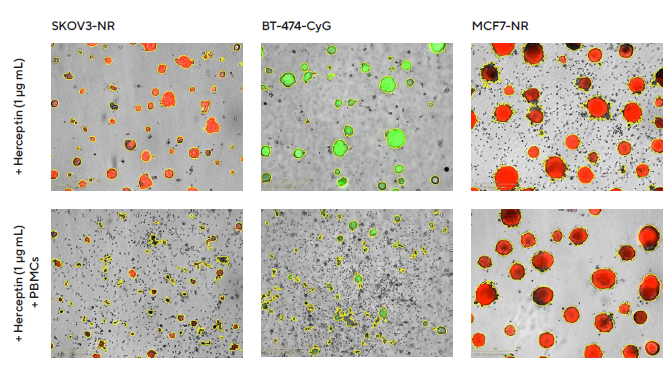 Impact of Herceptin-induced PBMCs on multi-spheroid proliferation. Tumor cells either stably expressing nuclear restricted RFP (SKOV3-NR, MCF7-NR) or cytoplasmically restricted GFP (BT-474-CyG) were seeded in flat bottom 96-well plates (1,000 cells/well on a bed of Matrigel). Multi-spheroids were allowed to form (3 d) prior to addition of freshly isolated PBMCs (E:T, 5:1) and Herceptin. Incucyte® S3 brightfield and fluorescence images (7 d; SKOV3-NR, MCF-NR or 10 d; BT-474-CyG) compare the effect of Herceptin on spheroid proliferation in absence (top panel) and presence (bottom panel) of PBMCs (Brightfield outline mask shown in yellow). Note the loss of fluorescence intensity in HER2- postive (SKOV3 and BT474) multi-spheroids in the presence of PBMCs.