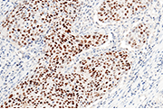 Immunochemical staining of p53 in human lung cancer.
