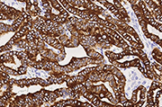 Immunochemical staining of human KRT19 in human thyroid cancer