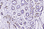 Immunochemical staining of human p63 in human breast carcinoma.