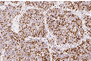 Immunochemical staining of human Ki67 in human lung cancer.