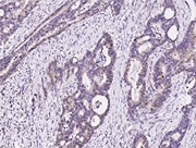 Immunochemical staining of cynomolgus IGFBP3 in human colon carcinoma.