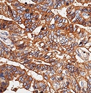 Immunochemical staining of human E-cadherin in human gastric cancer.