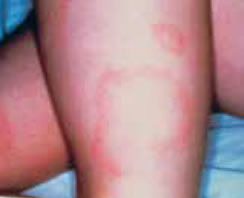 Erythema migrans rash on an arm