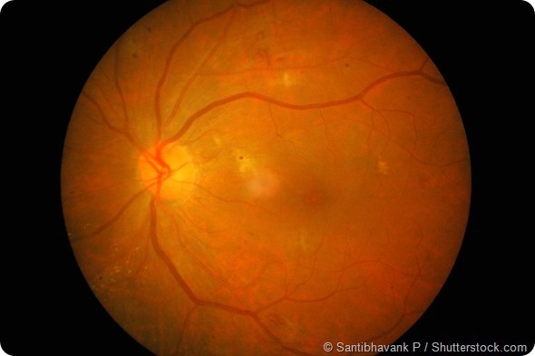 Retinal image of right eye in uncontrolled type II diabetes mellitus (DM) with decrease visual acuity (VA) and hyperglycemia
