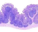 Severe COVID-19 found to be associated with disrupted intestinal Peyer’s patches