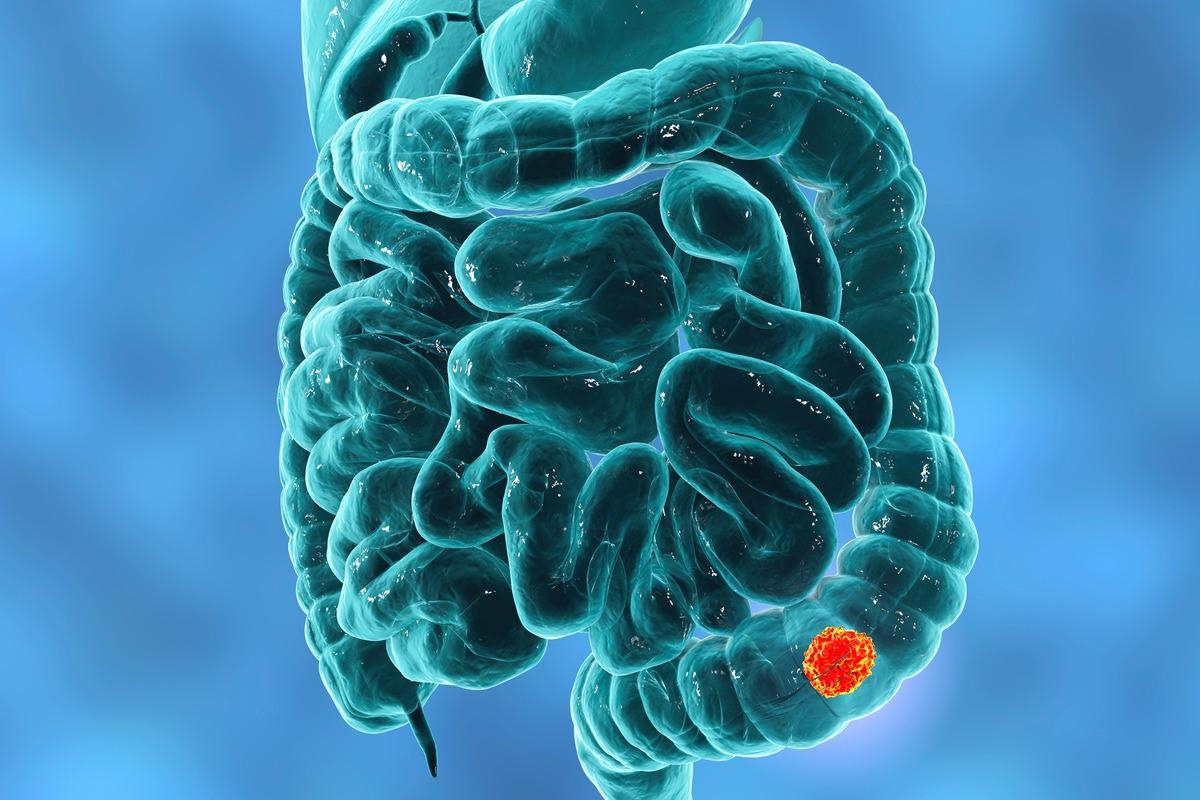 Study: first_pagesettings Open AccessArticle A Novel Urinary miRNA Biomarker for Early Detection of Colorectal Cancer. Image Credit: Kateryna Kon/Shutterstock