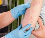 Study explores factors associated with COVID-19 vaccine hesitancy in individuals with psoriasis