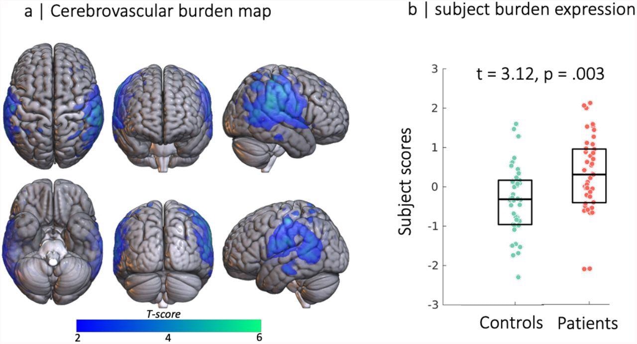 Source-based cerebrovasculometry for the component differentially expressed between groups: (left) independent component spatial map reflecting decrease in RSFA values in temporo-parietal regions. (right) Bar plot of subject scores for patients hospitalised for COVID-19 (red) and control group (green, each circle represents an individual) indicating higher loading values for patients than controls as informed by two-sample unpaired permutation test (a robust regression was used to down-weight the effects of extreme data points)