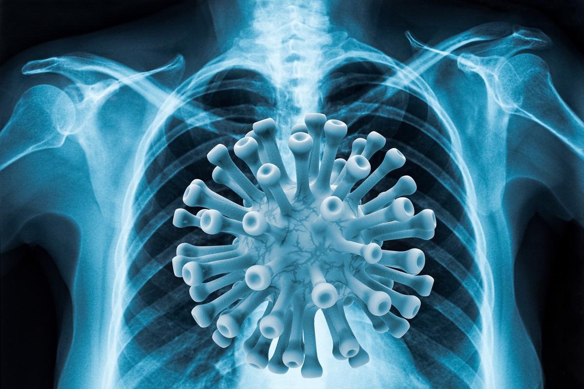 Study: SARS-CoV-2-specific T cells associate with reduced lung function and inflammation in pulmonary post-acute sequalae of SARS-CoV-2. Image Credit: AGCuesta/Shutterstock