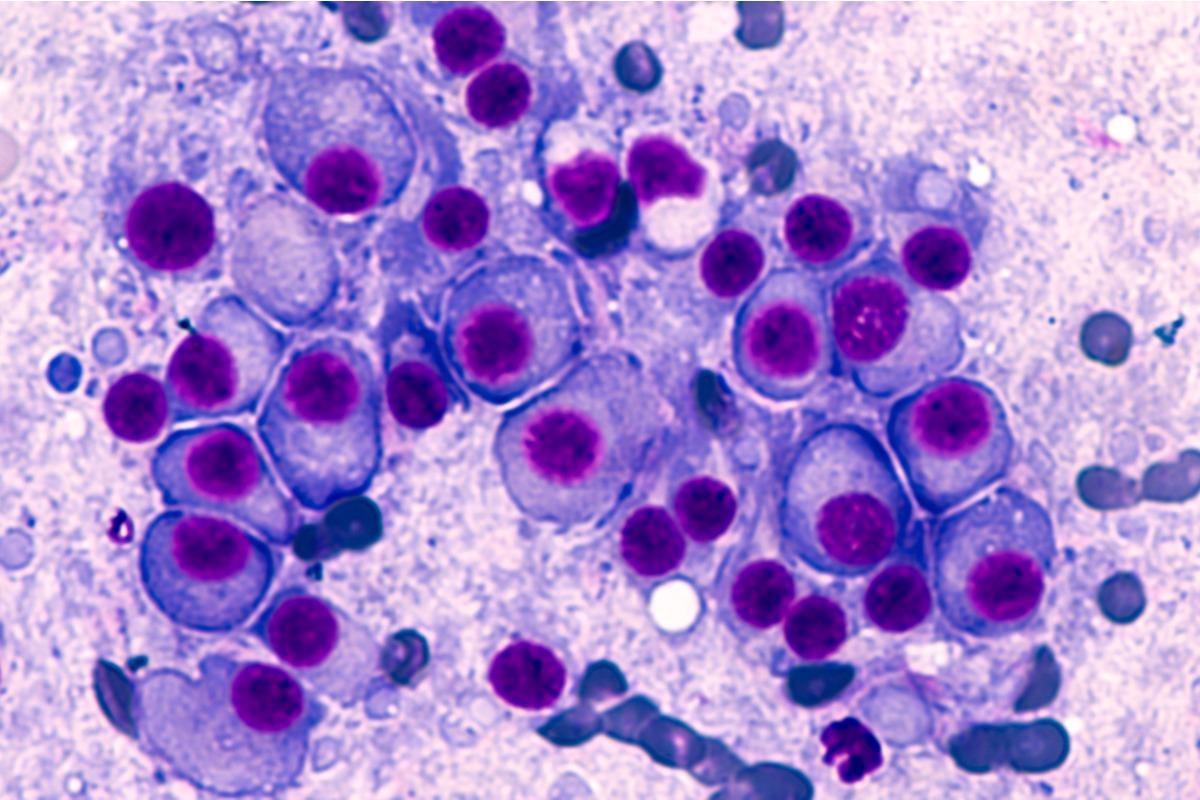 Study: Impact of Omicron variant on the response to SARS-CoV-2 mRNA Vaccination in multiple myeloma. Image Credit: David A Litman/Shutterstock