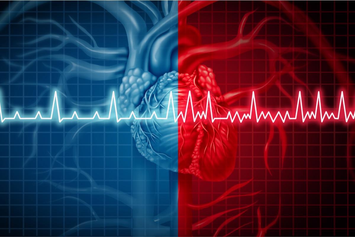 Study: Clinical Outcome of Hospitalized COVID-19 Patients with History of Atrial Fibrillation. Image Credit: Lightspring/Shutterstock