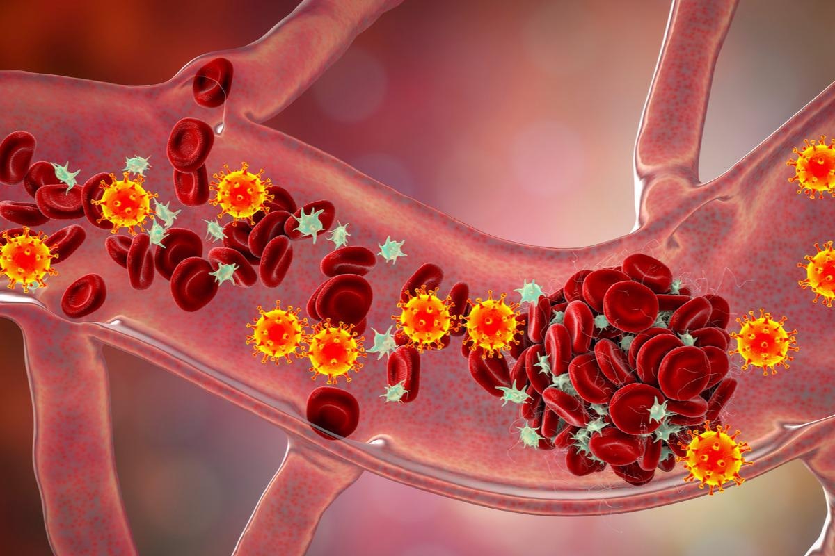 Study: Venous Thromboembolism in Ambulatory Covid-19 patients: Clinical and Genetic Determinants. Image Credit: Kateryna Kon / Shutterstock.com