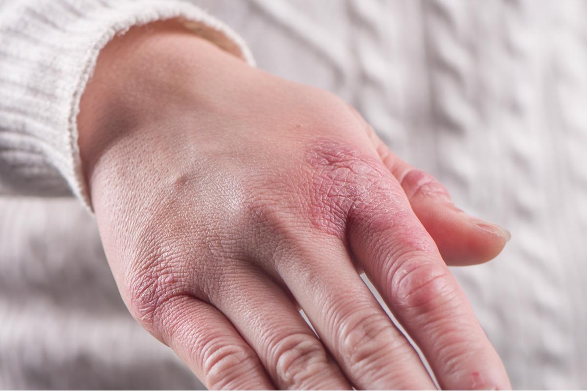 Study: Pandemic chilblains: Are they SARS-CoV-2-related or not? Image Credit: kungfu01 / Shutterstock.com