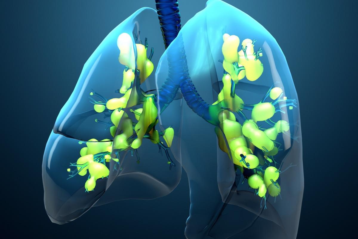Study: Lung targeted liposomes for treating ARDS. Image Credit:  Design_Cells/Shutterstock