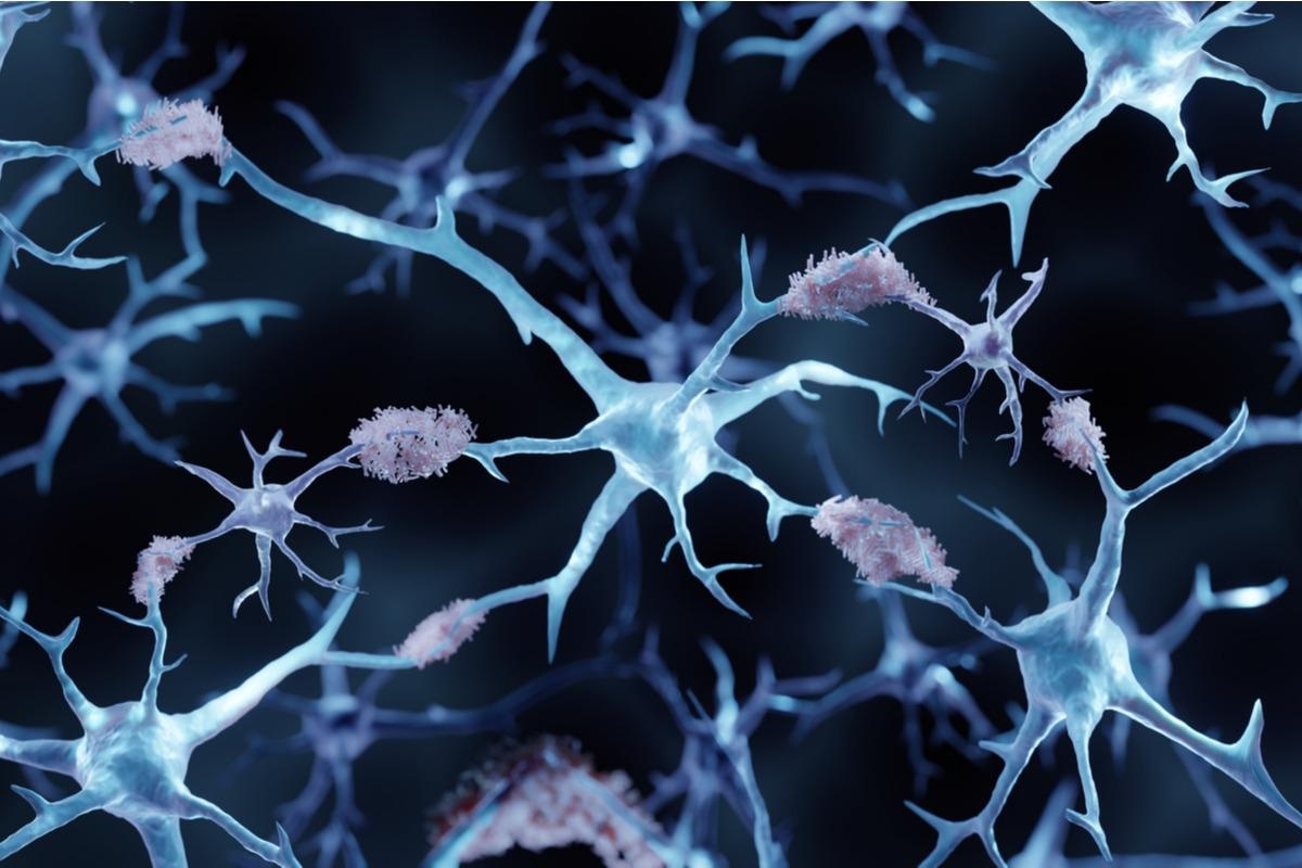 Study: New Insights into The Genetic Etiology of Alzheimer’s Disease and Related Dementias. Image Credit: ART-ur / Shutterstock.com