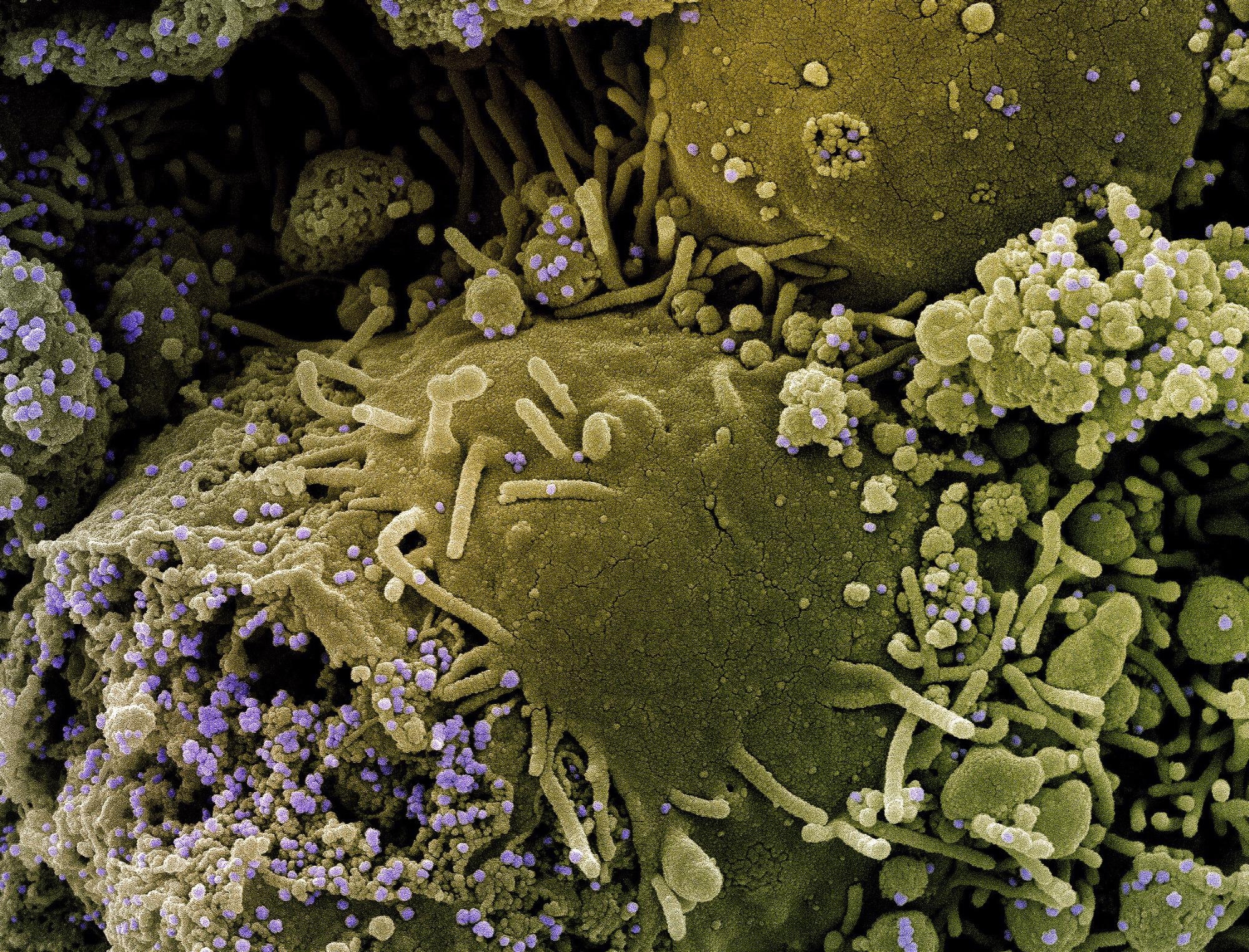 रोगी के नमूने से अलग किए गए SARS-CoV-2 वायरस कणों (बैंगनी) के एक प्रकार के तनाव से संक्रमित कालानुक्रमिक रूप से संक्रमित और आंशिक रूप से लाइस कोशिकाओं (जैतून का हरा) का रंगीन स्कैनिंग इलेक्ट्रॉन माइक्रोग्राफ। छवि क्रेडिट: NIAID