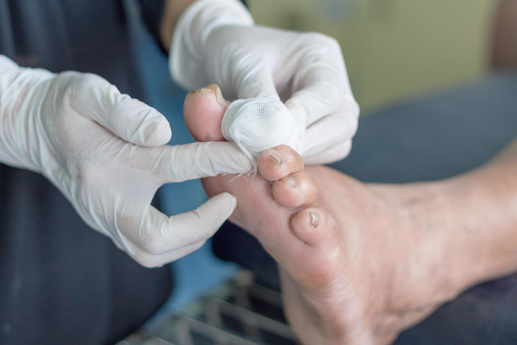 Study: Association of Race, Ethnicity, and Rurality With Major Leg Amputation or Death Among Medicare Beneficiaries Hospitalized With Diabetic Foot Ulcers. Image Credit: kirov1976 / Shutterstock