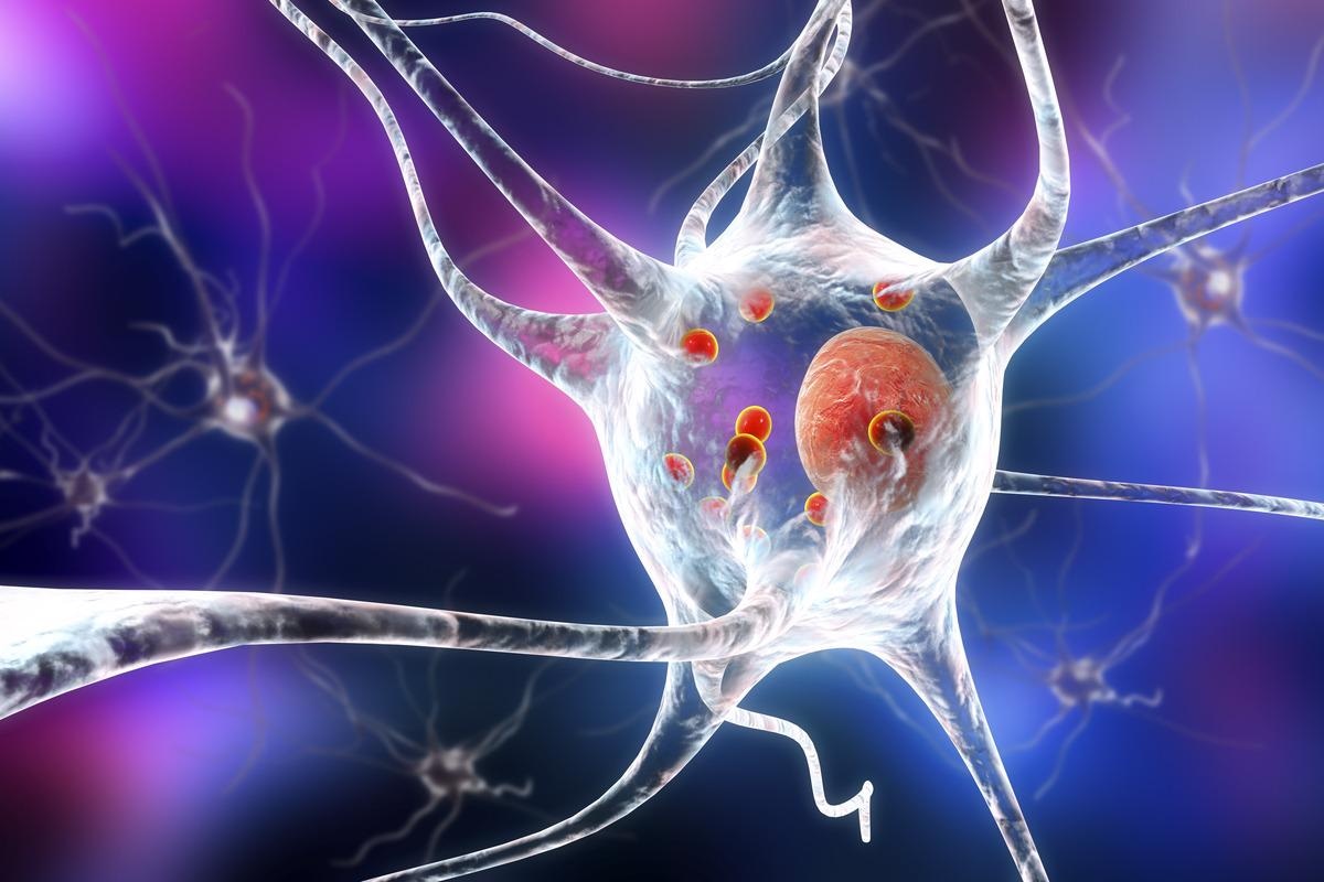 Study: Single-cell genomic profiling of human dopamine neurons identifies a population that selectively degenerates in Parkinson's disease.  Image Credit: Kateryna Kon / Shutterstock