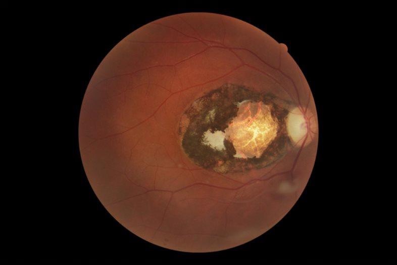 Ocular toxoplasmosis found to be common among Australians