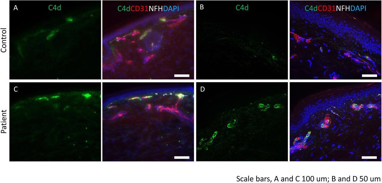 Complement deposition in skin of post-COVID-19 vaccine neuropathy: Immunostaining was performed for C4d (green), endothelial cell marker, CD31 (red) and neurofilament heavy chain, NFH (white). DAPI was used to stain the nuclei. (A and B) control tissues show minimal staining for C4d. CD31 identifies the endothelial cells in the blood vessels. (C and D) deposition of C4d is seen in the endothelial lining of the blood vessels. Scale bars: A and C are 100 mm and B and D are 50 mm.