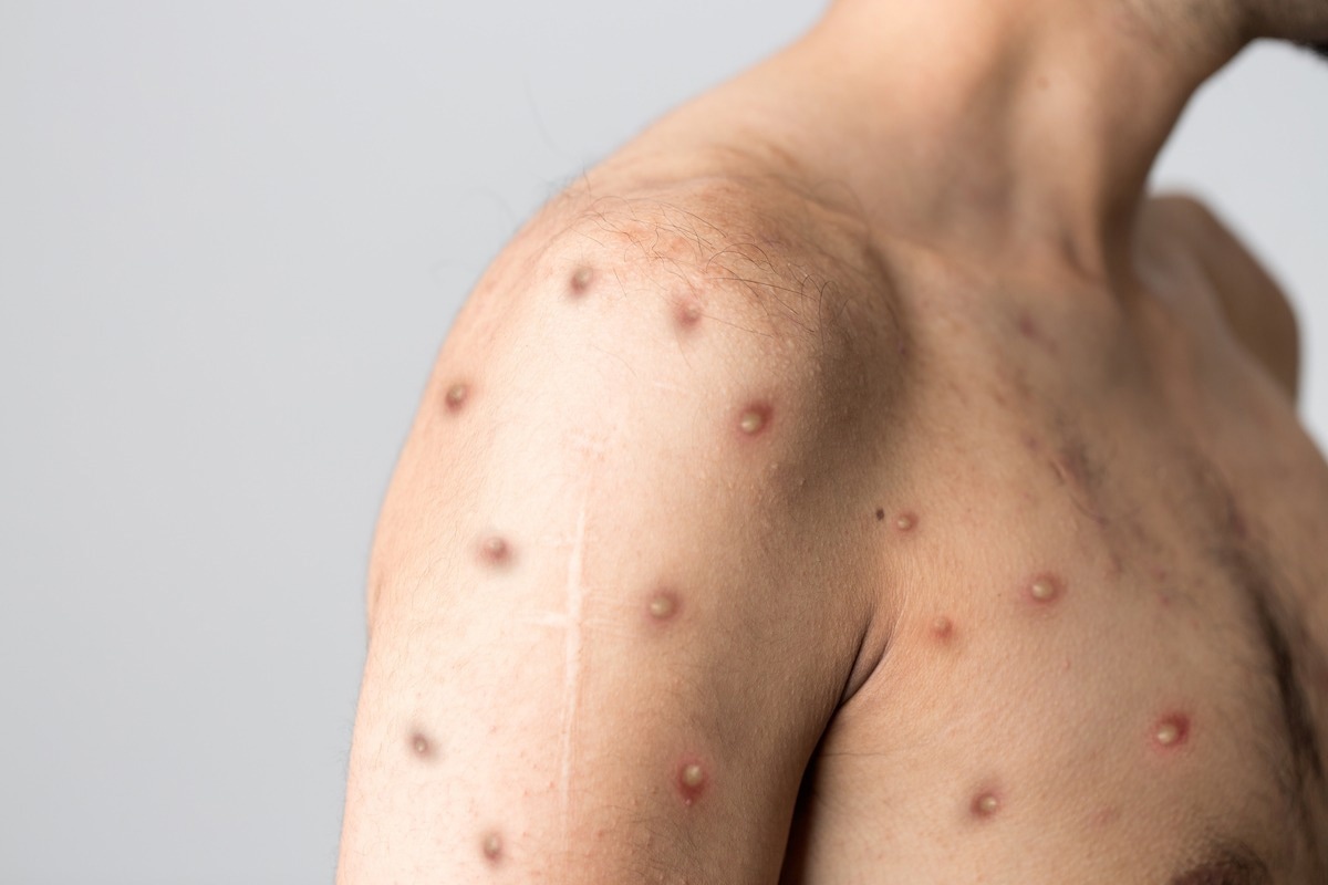 Study: Monkeypox infection in a developed country: A Case Report. Image Credit: Berkay Ataseven/Shutterstock