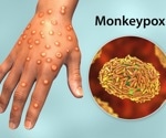 CDC experts update on monkeypox in the United States