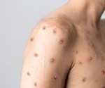 Case series of first 3 monkeypox patients in Massachusetts treated with tecoviromat