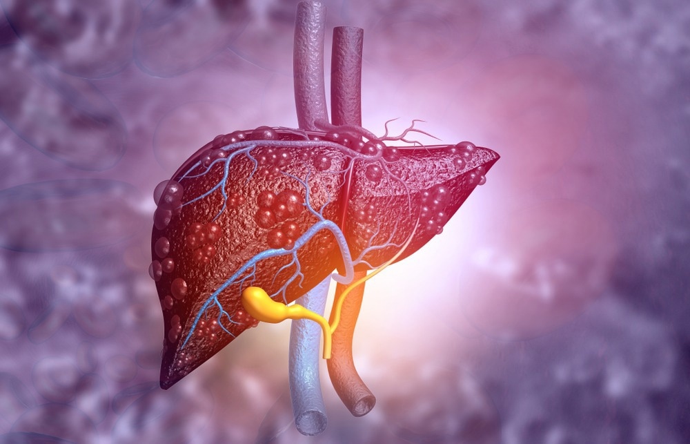 Study: Exposure to perfluoroalkyl substances and risk of hepatocellular carcinoma in a multiethnic cohort. Image Credit: Explode/Shutterstock