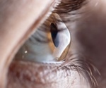 Bioengineered corneal tissue implantation restores vision in advanced keratoconus