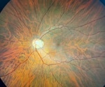 Researchers assess lutein nanodisks against ultraviolet light-induced retinal damage