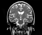 MRI shows brain microstructural changes after mild COVID-19