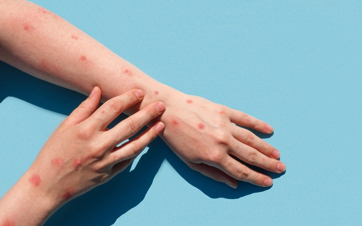 Study: Public understanding, awareness, and response to monkeypox virus outbreak: A cross-sectional survey of the most affected communities in the United Kingdom during the 2022 public health emergency. Image Credit: Marina Demidiuk/Shutterstock