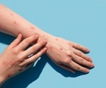 UK survey reveals outlook of the public towards health information circulating during the 2022 monkeypox virus outbreak